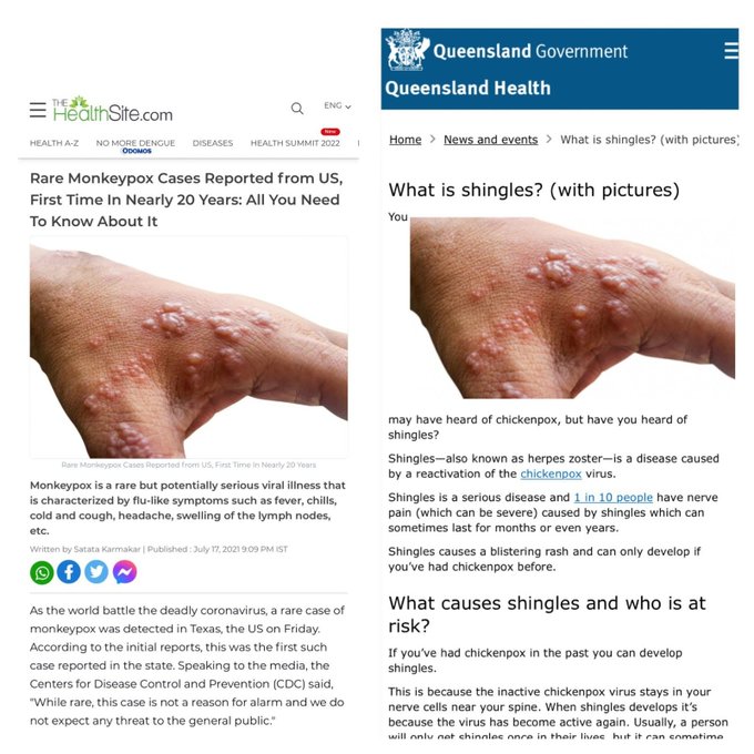 shingles or monkeypox